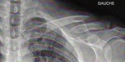 Clavicule gauche