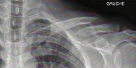 Clavicule gauche