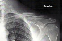 Clavicule, suite et fin