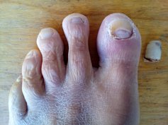 L'ongle qui s'était fait la malle