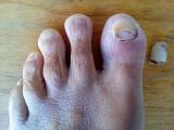 What happend to my toe nail?!